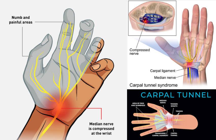 Carpal Tunnel Syndrome